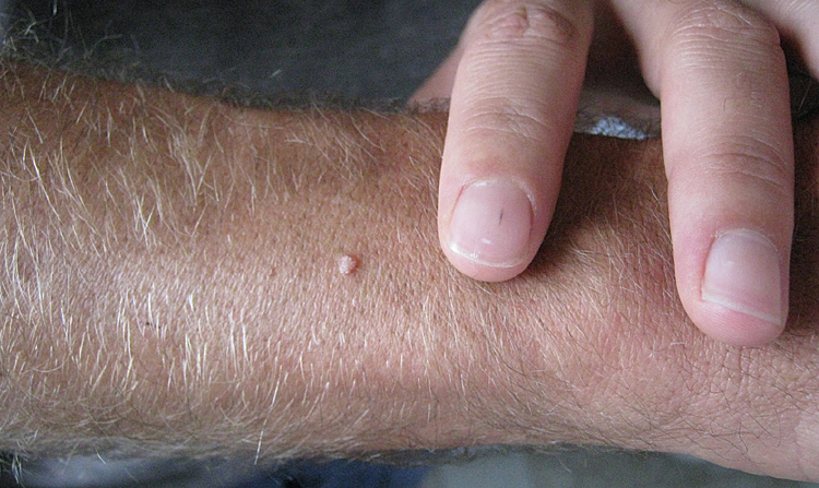 Warts On Arm - Doctor answers on HealthTap