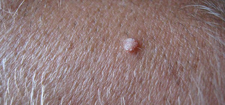 Warts on Forearm | Warts Pictures - Amoils.com