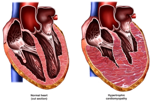 Hypertrophic Cardiomyopathy_New