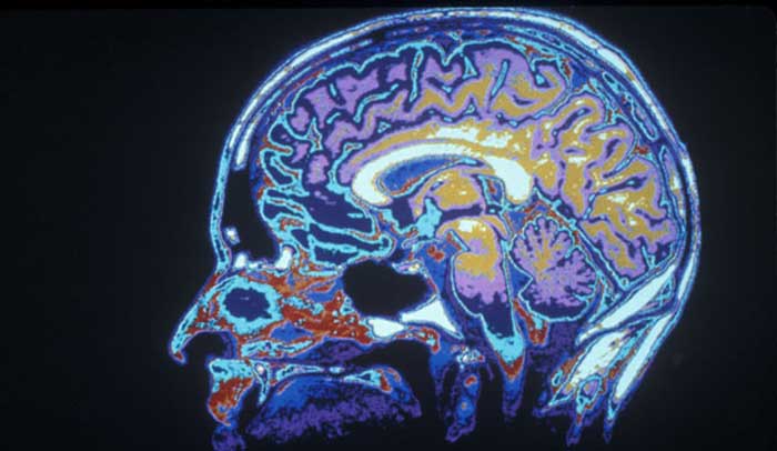 neurotoxicity-brain-mold