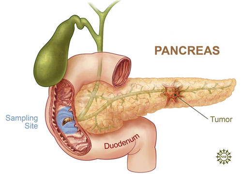pancreatic-cancer-and-scuba-diving