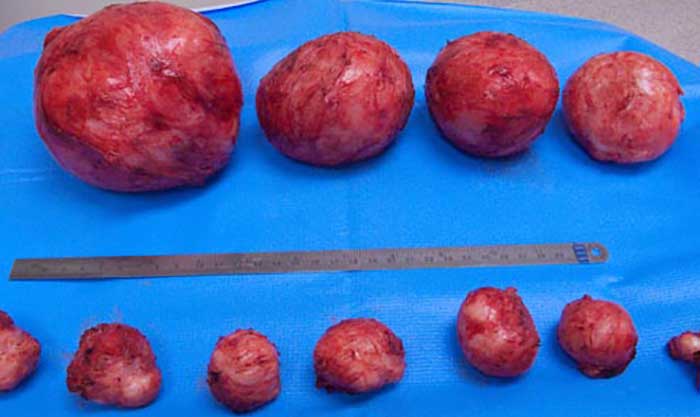 natural-uterine-fibroid-cure