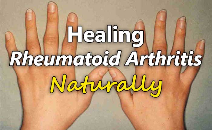 rhumatoid-arthritis-hands-swelling